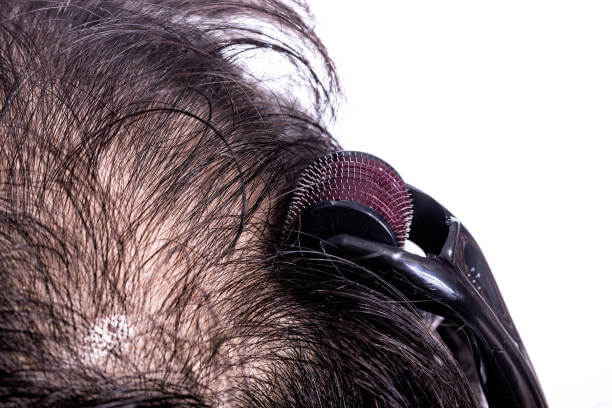 Microneedling with light therapy for skin, scalp and hair