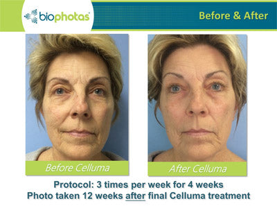 Red & LED Light Therapy: Before and After Results Photos