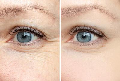 Eye Wrinkles Before and After using Celluma's Light Therapy