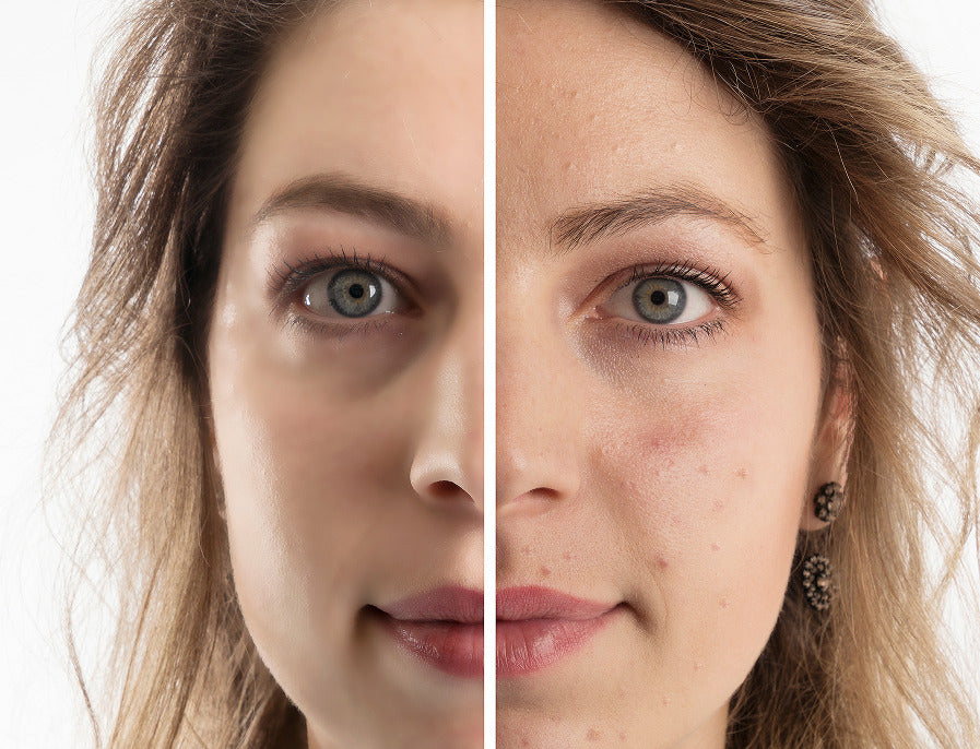Acne Treatment of Woman Before & After Results