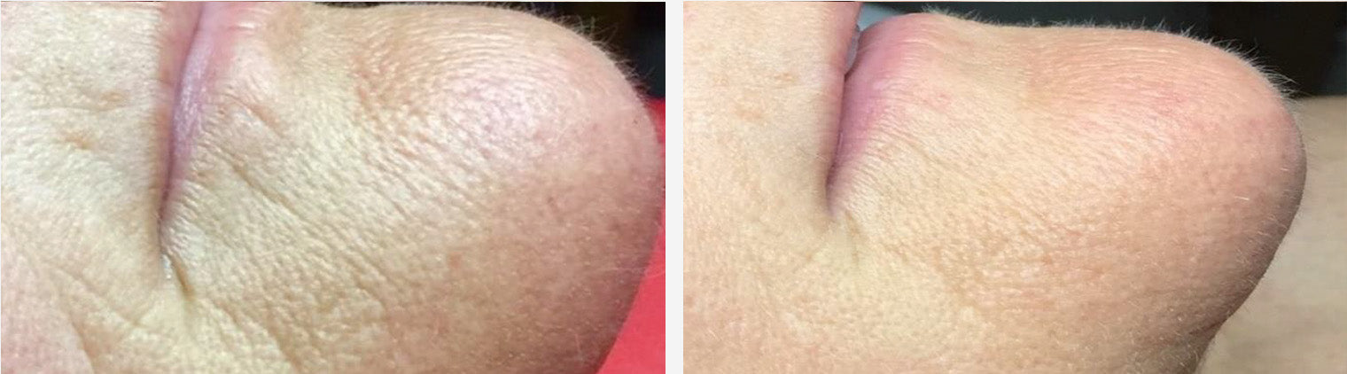 Wrinkles Around Chin Before/After