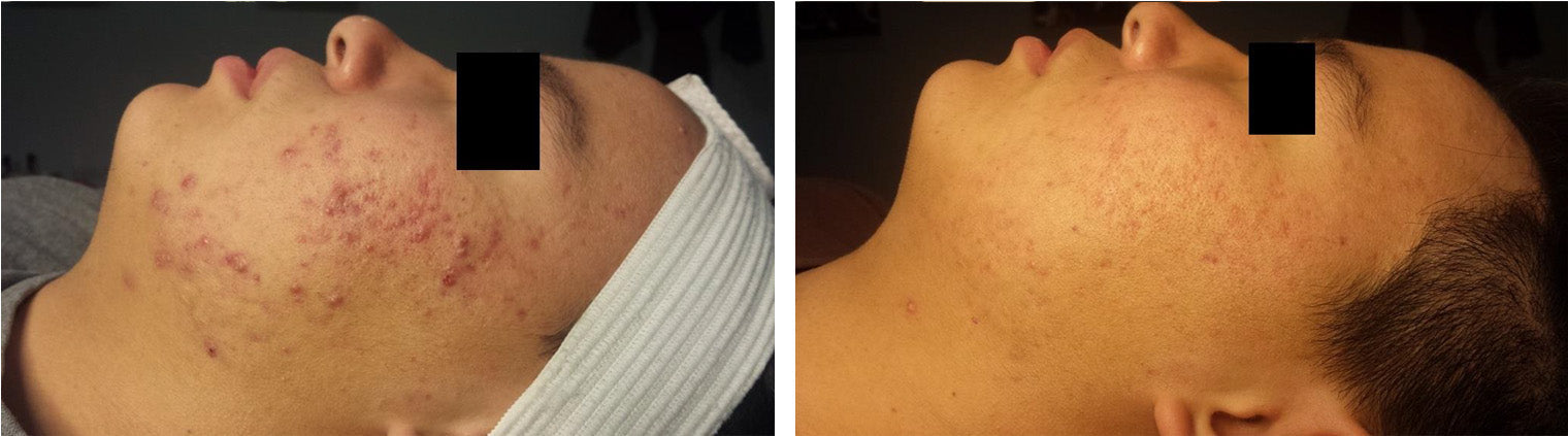 Acne Treatment Before/After