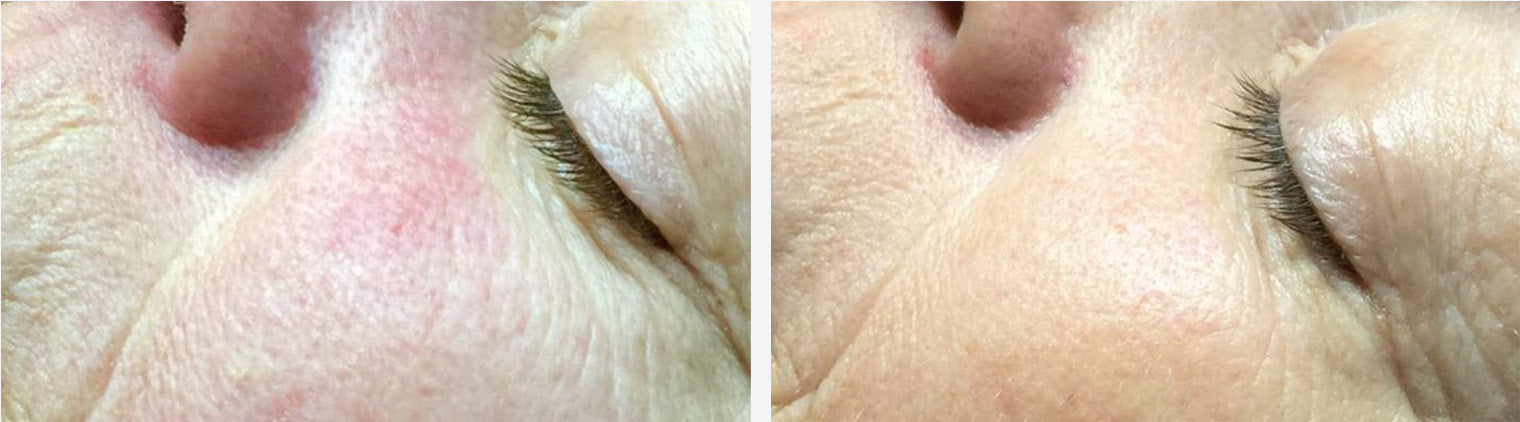 Smoother Lips Before/After