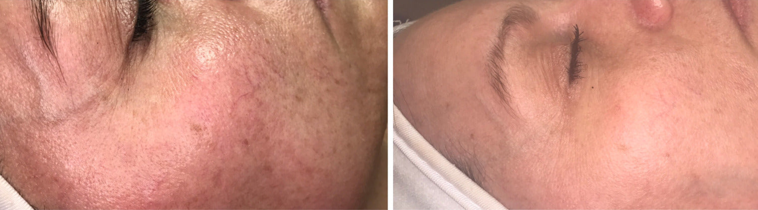Sun Spots on Skin Before/After