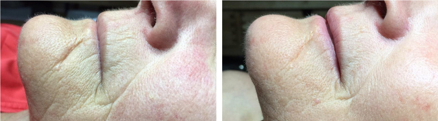 Anti-Aging Around Mouth Before/After